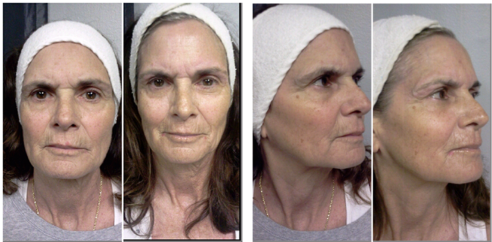 Nano Micro Current Facial Lifting San Diego Advanced Skincare